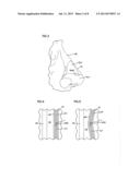 NASAL VALVE TREATMENT METHOD & APPARATUS diagram and image