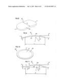 NASAL VALVE TREATMENT METHOD & APPARATUS diagram and image