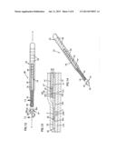 NASAL VALVE TREATMENT METHOD & APPARATUS diagram and image