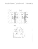 NASAL VALVE TREATMENT METHOD & APPARATUS diagram and image