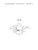 MINIMALLY INVASIVE INTERVERTEBRAL STAPLE DISTRACTION DEVICES diagram and image