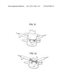 MINIMALLY INVASIVE INTERVERTEBRAL STAPLE DISTRACTION DEVICES diagram and image