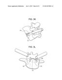 MINIMALLY INVASIVE INTERVERTEBRAL STAPLE DISTRACTION DEVICES diagram and image