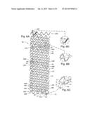 Intraluminal Stent diagram and image