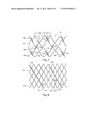 Intraluminal Stent diagram and image