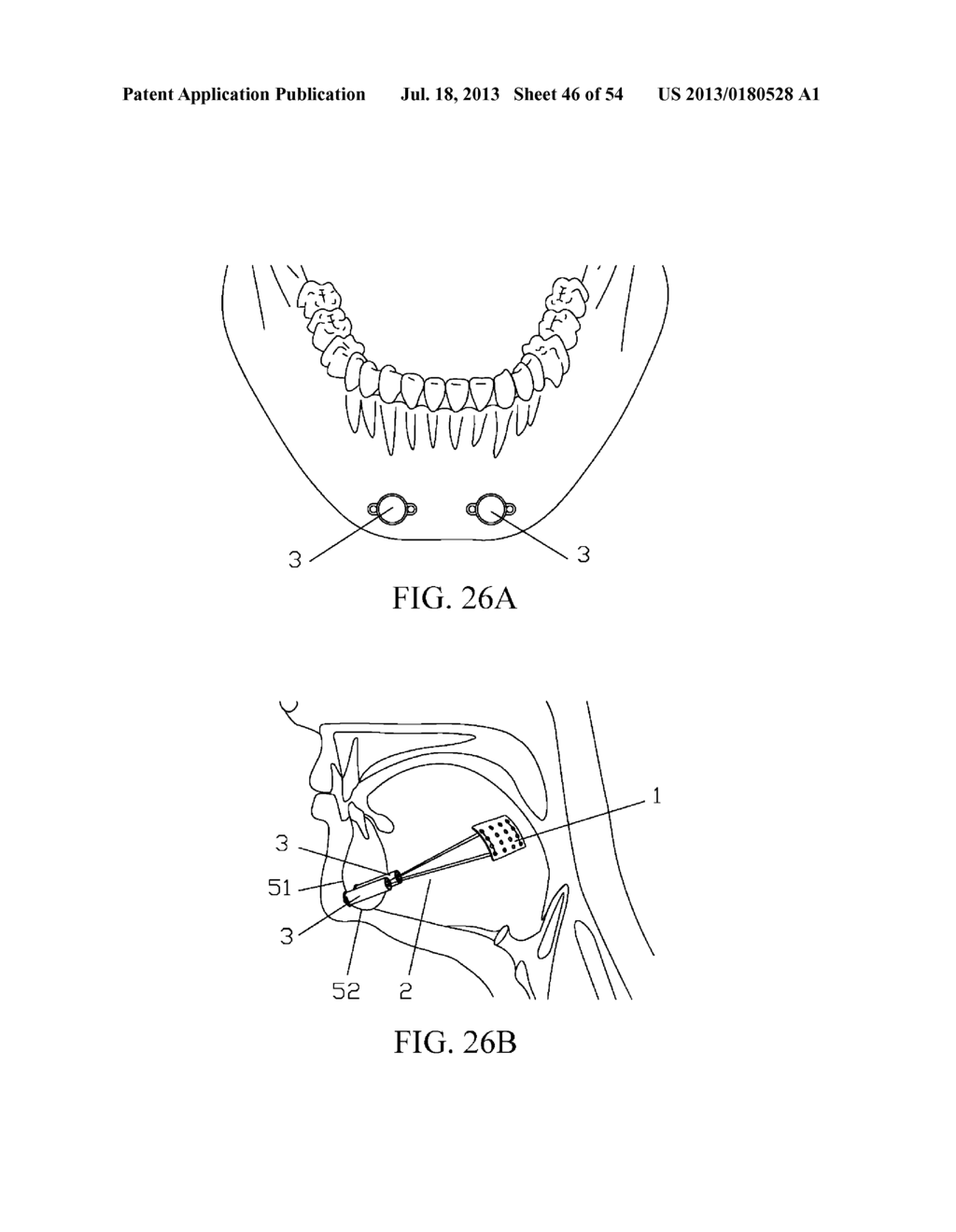 IMPLANTED TONGUE PULLING DEVICE, PULL PLATE, PULL LINE, RETRACTOR AND     METHOD - diagram, schematic, and image 47