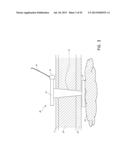 EXPANDABLE TISSUE RETRACTION DEVICES diagram and image