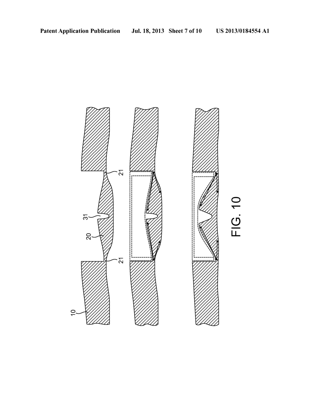 DEVICE FOR MONITORING INTRAOCULAR PRESSURE - diagram, schematic, and image 08