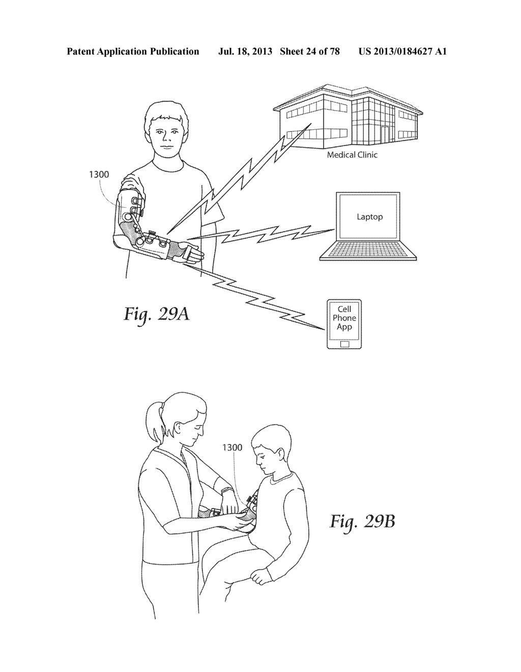 Systems, Devices, and Methods for Mechanically Reducing and Fixing Bone     Fractures - diagram, schematic, and image 25