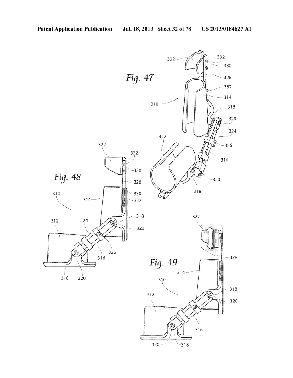 Systems, Devices, and Methods for Mechanically Reducing and Fixing Bone     Fractures - diagram, schematic, and image 33