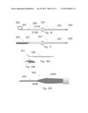 Method, Surgical Kit and Device for Treating Glaucoma diagram and image