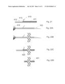 Method, Surgical Kit and Device for Treating Glaucoma diagram and image