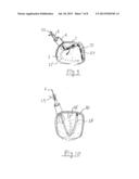 APPARATUS AND METHOD FOR INTRA-CARDIAC MAPPING AND ABLATION diagram and image