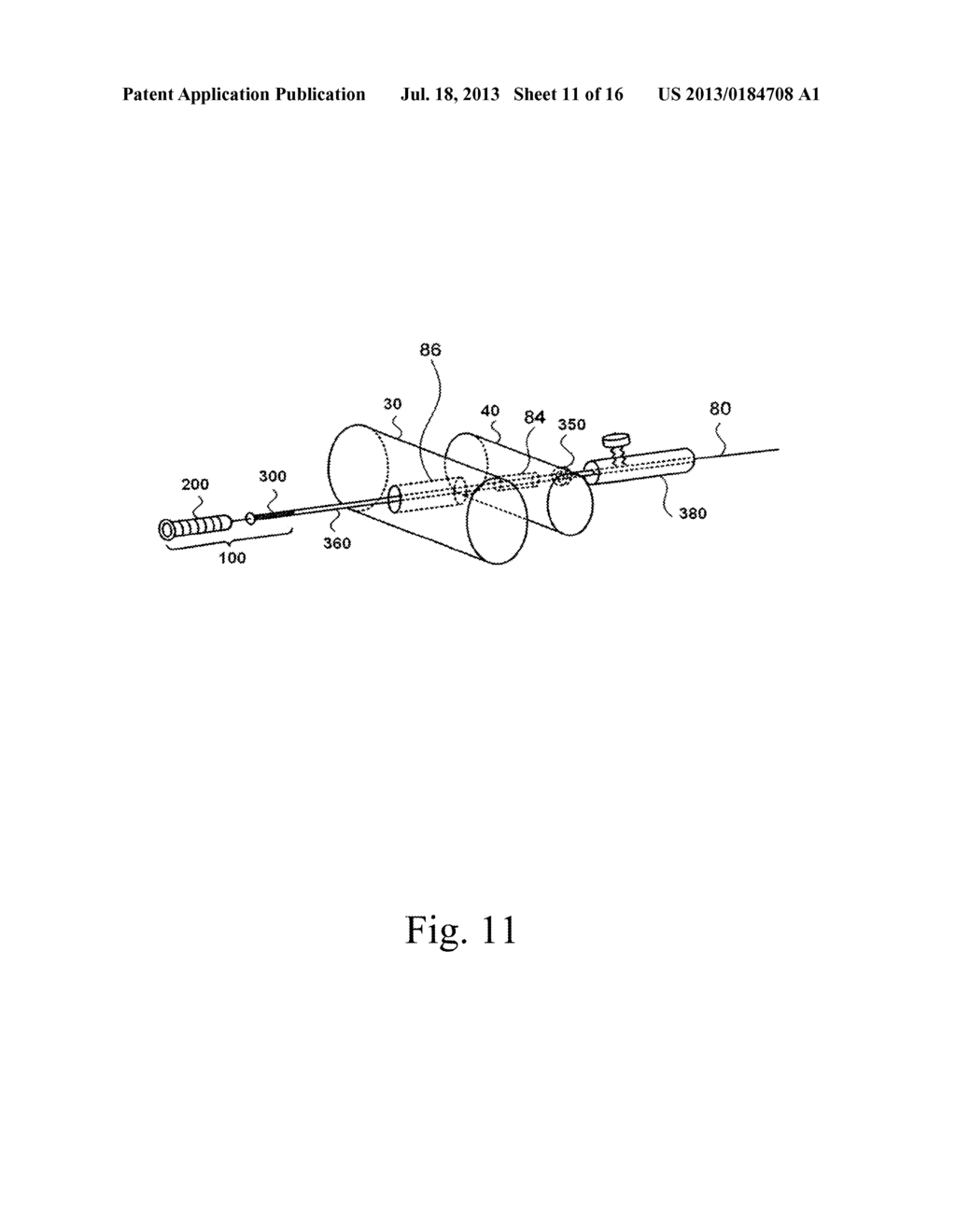 ORTHOPEDIC IMPLANT FOR TREATMENT OF BONE DEFORMITIES - diagram, schematic, and image 12