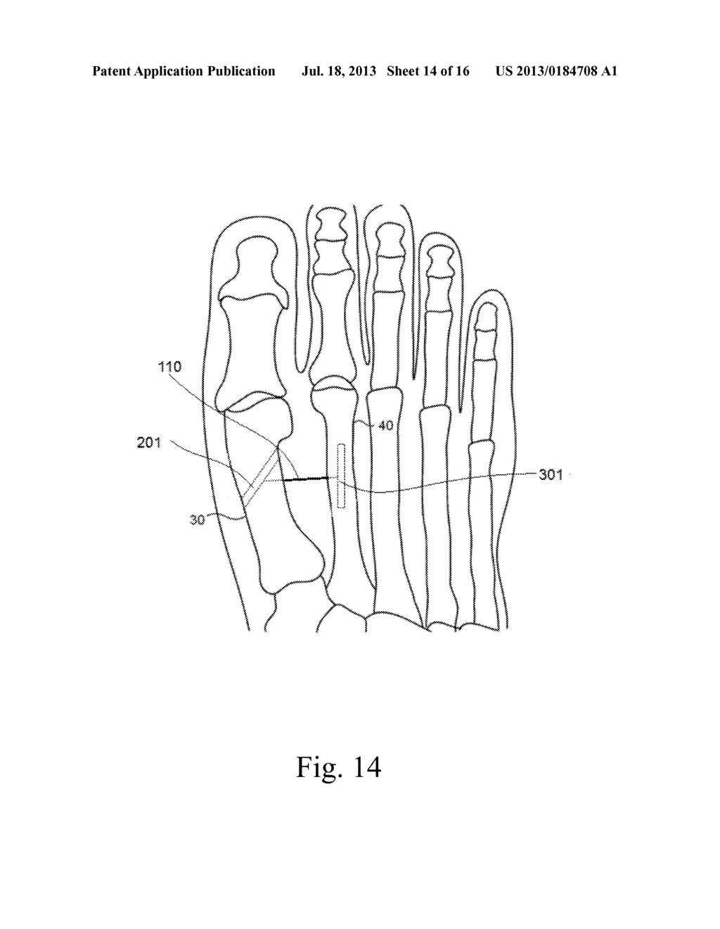 ORTHOPEDIC IMPLANT FOR TREATMENT OF BONE DEFORMITIES - diagram, schematic, and image 15