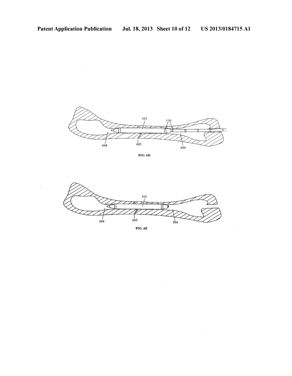 Systems and Methods for Internal Bone Fixation - diagram, schematic, and image 11