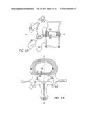 BONE ANCHOR SYSTEMS diagram and image