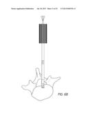 BONE ANCHOR SYSTEMS diagram and image