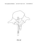 BONE ANCHOR SYSTEMS diagram and image