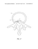 BONE ANCHOR SYSTEMS diagram and image