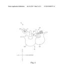 SEMI-CONSTRAINED ANCHORING SYSTEM diagram and image