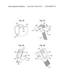 LOW-PROFILE, UNIPLANAR BONE SCREW diagram and image