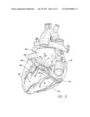 LEAD SHAPED FOR STIMULATION AT THE BASE LEFT VENTRICLE diagram and image