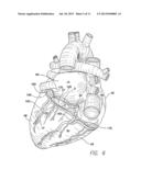 LEAD SHAPED FOR STIMULATION AT THE BASE LEFT VENTRICLE diagram and image