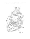 LEAD SHAPED FOR STIMULATION AT THE BASE LEFT VENTRICLE diagram and image