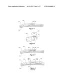 IMPLANTABLE COMPONENT INTERFACE diagram and image