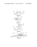 IMPLANTABLE COMPONENT INTERFACE diagram and image