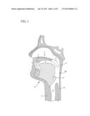 IMPLANT SYSTEMS AND METHODS FOR TREATING OBSTRUCTIVE SLEEP APNEA diagram and image