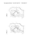 IMPLANT SYSTEMS AND METHODS FOR TREATING OBSTRUCTIVE SLEEP APNEA diagram and image