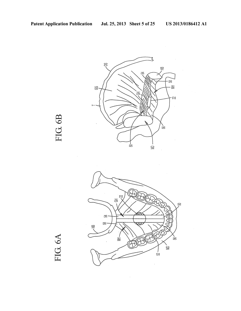 IMPLANT SYSTEMS AND METHODS FOR TREATING OBSTRUCTIVE SLEEP APNEA - diagram, schematic, and image 06