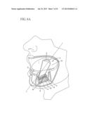 IMPLANT SYSTEMS AND METHODS FOR TREATING OBSTRUCTIVE SLEEP APNEA diagram and image