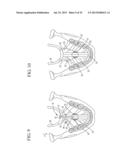 IMPLANT SYSTEMS AND METHODS FOR TREATING OBSTRUCTIVE SLEEP APNEA diagram and image