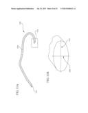 IMPLANT SYSTEMS AND METHODS FOR TREATING OBSTRUCTIVE SLEEP APNEA diagram and image