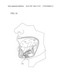 IMPLANT SYSTEMS AND METHODS FOR TREATING OBSTRUCTIVE SLEEP APNEA diagram and image