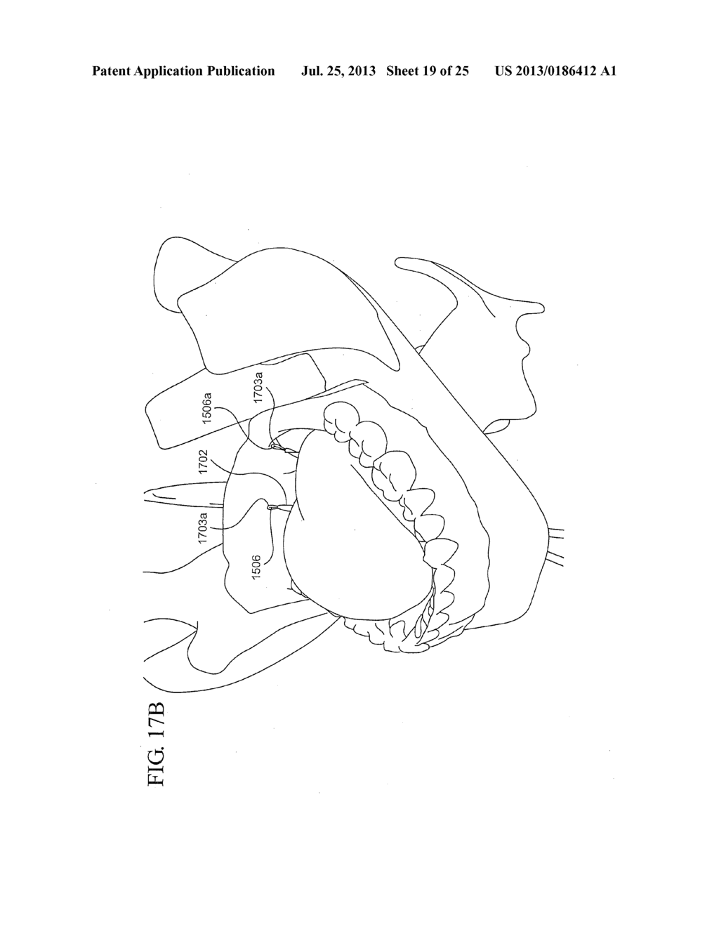 IMPLANT SYSTEMS AND METHODS FOR TREATING OBSTRUCTIVE SLEEP APNEA - diagram, schematic, and image 20