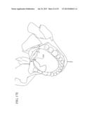 IMPLANT SYSTEMS AND METHODS FOR TREATING OBSTRUCTIVE SLEEP APNEA diagram and image