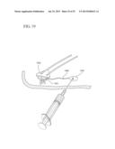 IMPLANT SYSTEMS AND METHODS FOR TREATING OBSTRUCTIVE SLEEP APNEA diagram and image