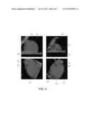 METHODS AND SYSTEMS FOR DETERMINING THE VOLUME OF EPICARDIAL FAT FROM     VOLUMETRIC IMAGES diagram and image