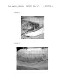 DEVICE FOR USE IN ENDOLUMINAL VACUUM THERAPY diagram and image