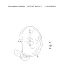 CUSTOMIZED PATIENT-SPECIFIC TIBIAL CUTTING BLOCKS diagram and image