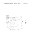 CUSTOMIZED PATIENT-SPECIFIC TIBIAL CUTTING BLOCKS diagram and image