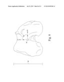 CUSTOMIZED PATIENT-SPECIFIC TIBIAL CUTTING BLOCKS diagram and image