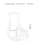 CUSTOMIZED PATIENT-SPECIFIC TIBIAL CUTTING BLOCKS diagram and image