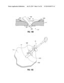 Reusable Surgical Retrieval Apparatus with Disposable Cartridge Assembly diagram and image