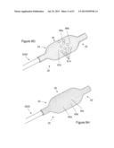  INFLATABLE MEDICAL DEVICES  diagram and image