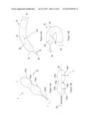  INFLATABLE MEDICAL DEVICES  diagram and image